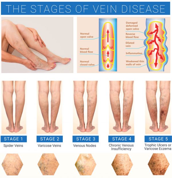 Vein Disease | Vein Institute Of Pinellas | Insurance Covered Treatment