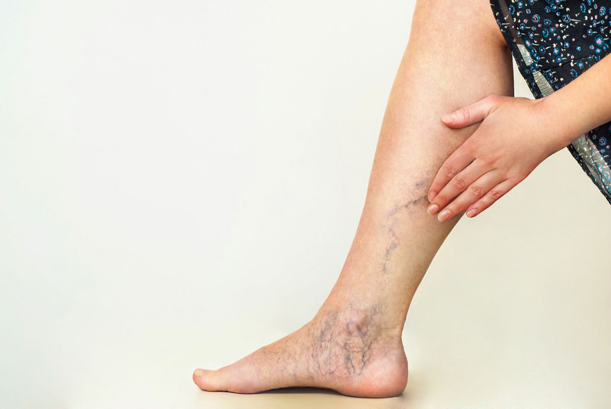 Reduce the Risk of Varicose Veins With the Help of Great Home Remedies