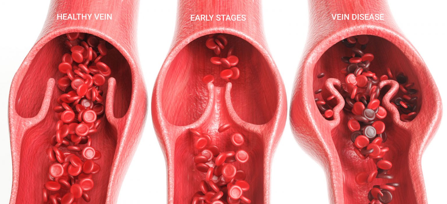 The Early Warning Signs of Vein Disease - Vein Institute Of Pinellas