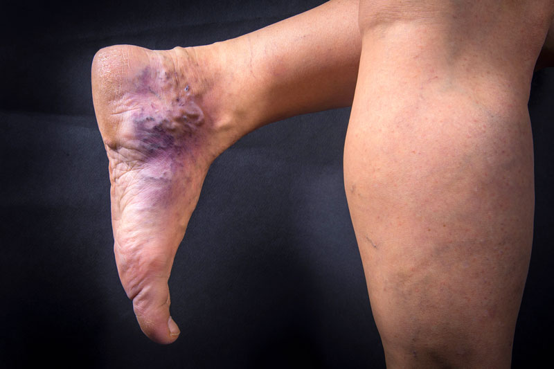 Ankle Discoloration: Causes and Treatment Options - Vein & Endovascular  Medical Care