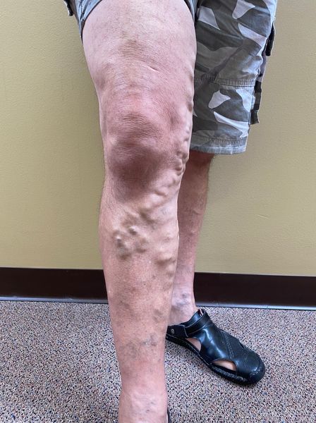 Before Vein Treatment