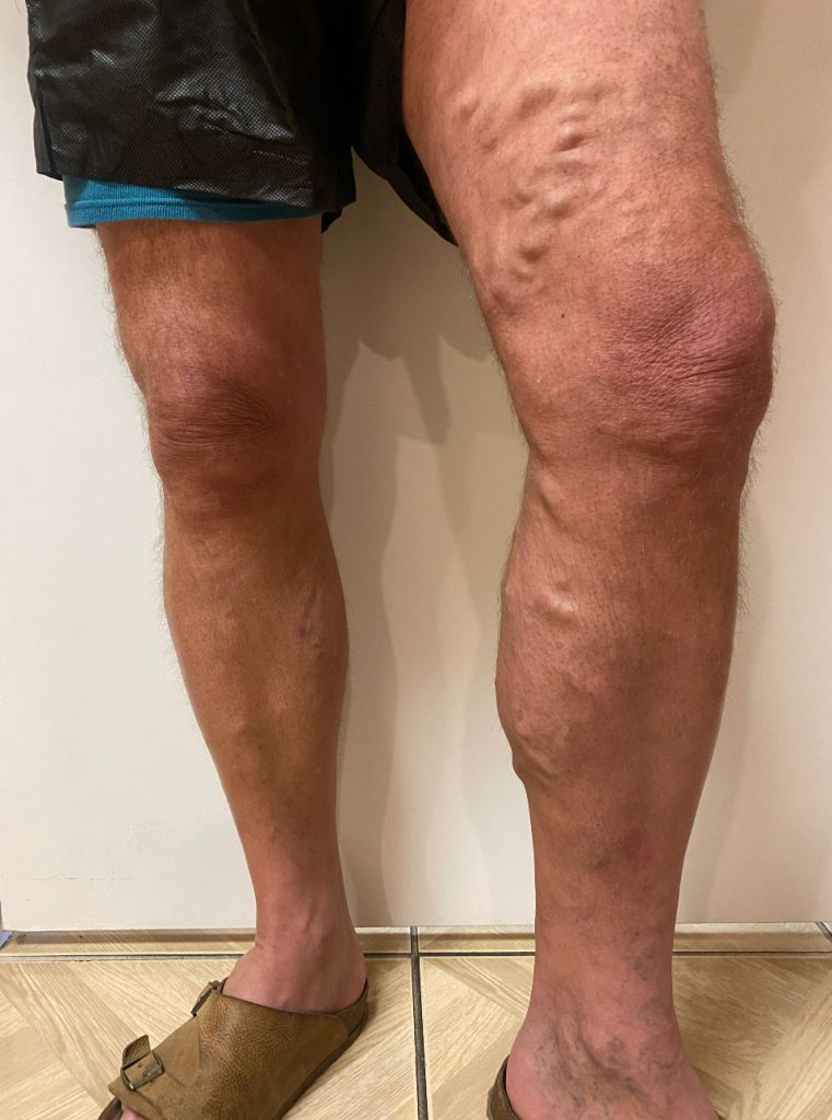 Varicose Vein Treatment Before
