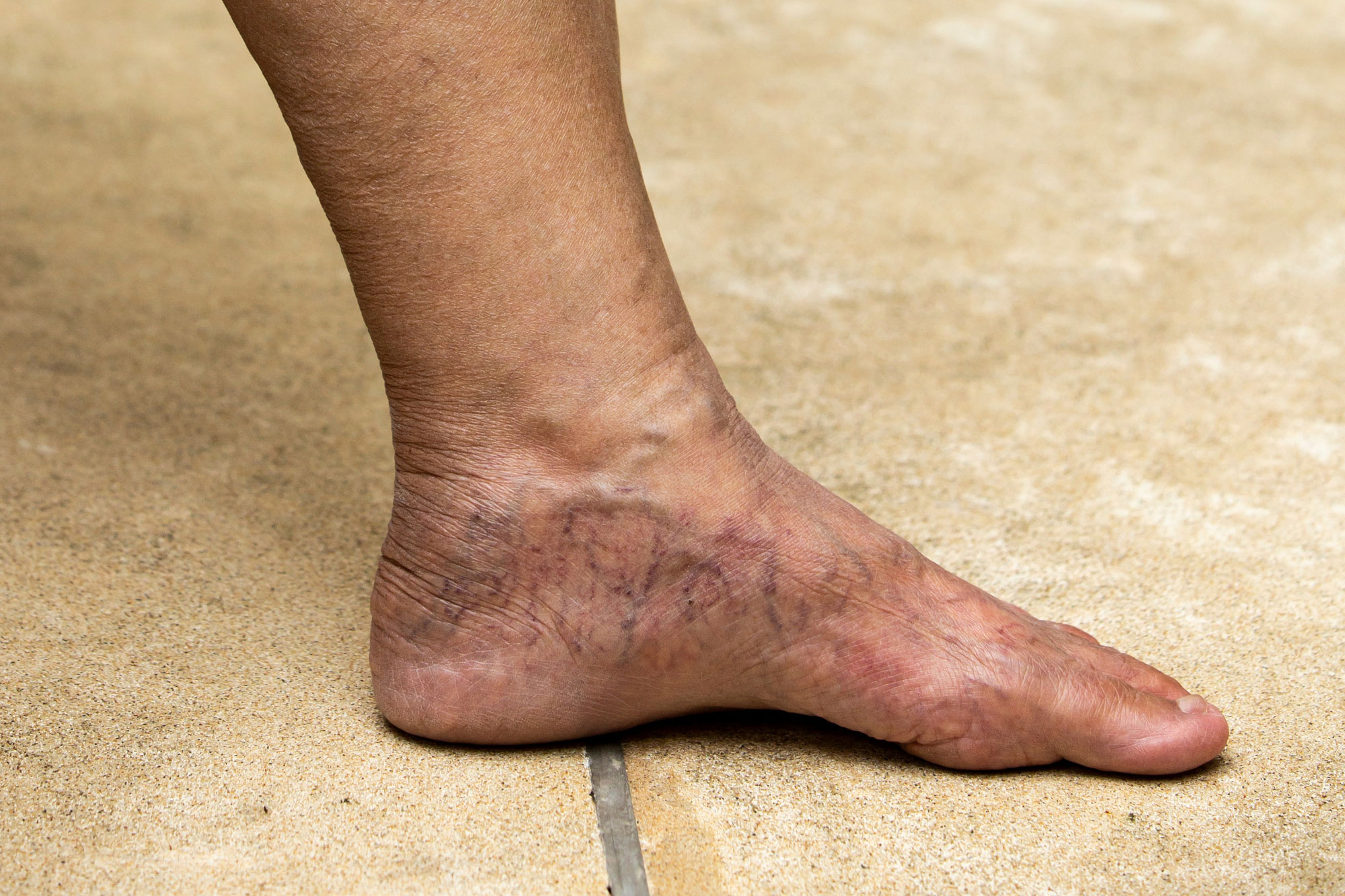 Understanding Varicose Veins In The Feet Vein Institute Of Pinellas